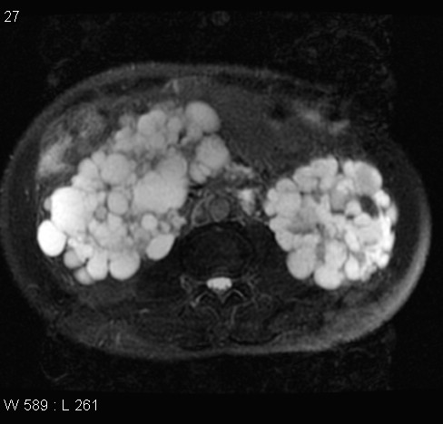 File:Autosomal dominant polycystic kidney disease (Radiopaedia 5202-6969 Axial T2 fat sat 11).jpg