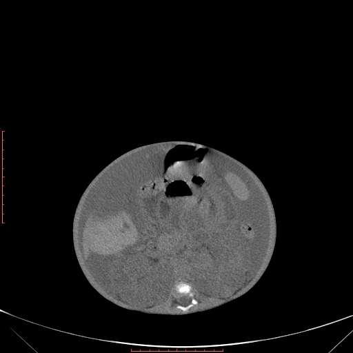 Autosomal recessive polycystic kidney disease associated with Caroli disease (Radiopaedia 61932-69984 Axial non-contrast 208).jpg
