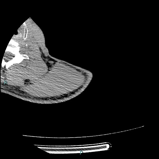 File:Avascular necrosis after fracture dislocations of the proximal humerus (Radiopaedia 88078-104655 D 13).jpg