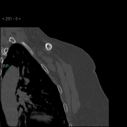 Avascular necrosis of the shoulder - Cruess stage I (Radiopaedia 77674-89887 Coronal bone window 2).jpg