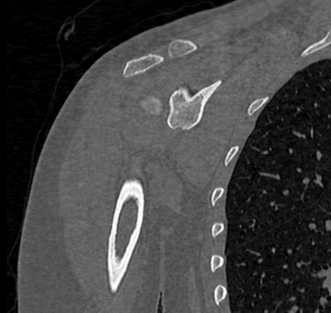 Avulsion fracture - greater tuberosity of humerus (Radiopaedia 71216-81514 Coronal bone window 36).jpg