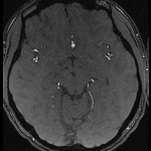 File:Azygos anterior cerebral artery (Radiopaedia 17059-16756 Axial MRA 35).jpg