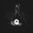 Balo concentric sclerosis (Radiopaedia 50458-55940 Axial DWI 21).jpg