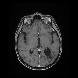Balo concentric sclerosis (Radiopaedia 53875-59982 Axial LAVA C+ 131).jpg