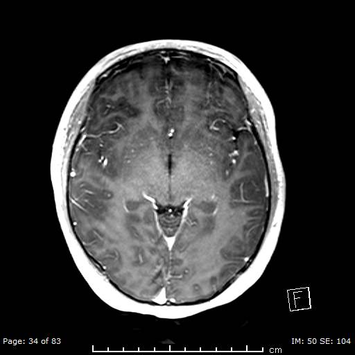File:Balo concentric sclerosis (Radiopaedia 61637-69636 Axial T1 C+ 34).jpg