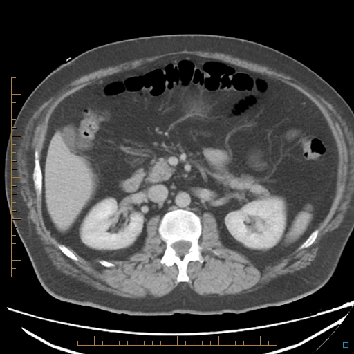 File:Bariatric balloon causing gastric outlet obstruction (Radiopaedia 54449-60672 A 17).jpg