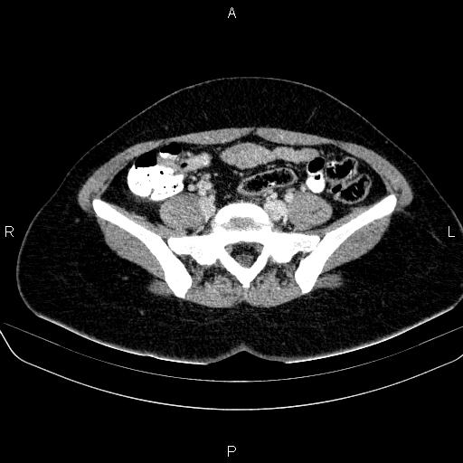 File:Bartholin gland cyst (Radiopaedia 62635-70930 Axial Post contrast 14).jpg