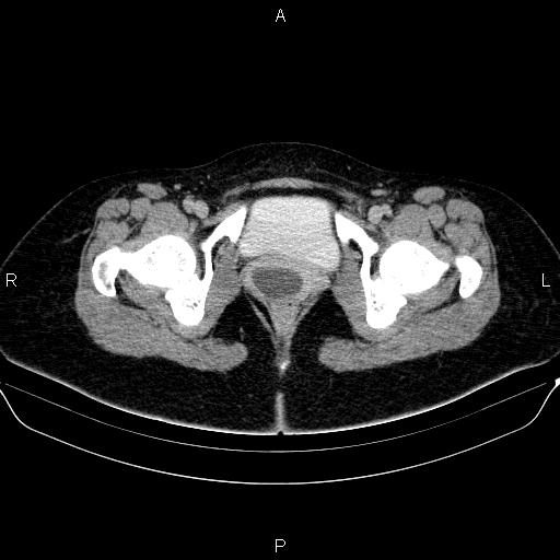 Bartholin gland cyst (Radiopaedia 62635-70930 C 74).jpg