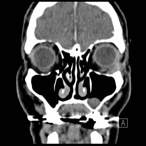 File:Basal cell carcinoma (periocular with orbital invasion) (Radiopaedia 30974-31672 Coronal Postcontrast 12).jpg
