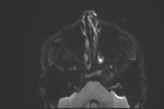 File:Basal cell carcinoma - nasal region (Radiopaedia 70292-80365 Axial DWI 28).jpg