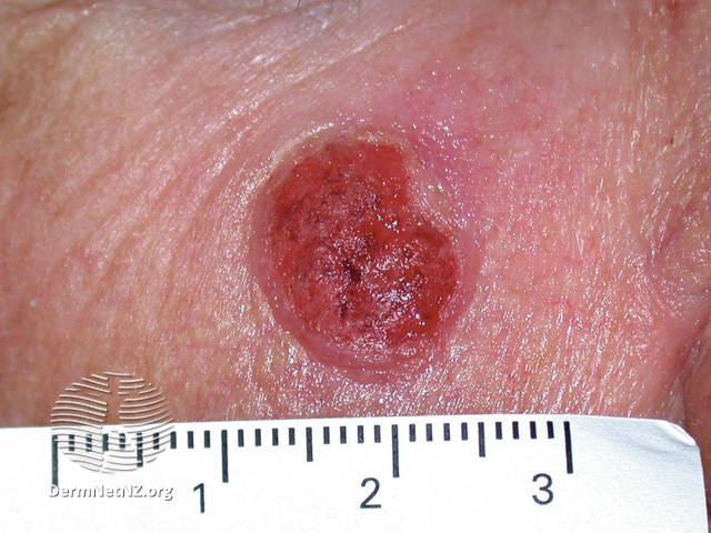 File:Basal cell carcinoma affecting the face (DermNet NZ lesions-bcc-face-1204).jpg