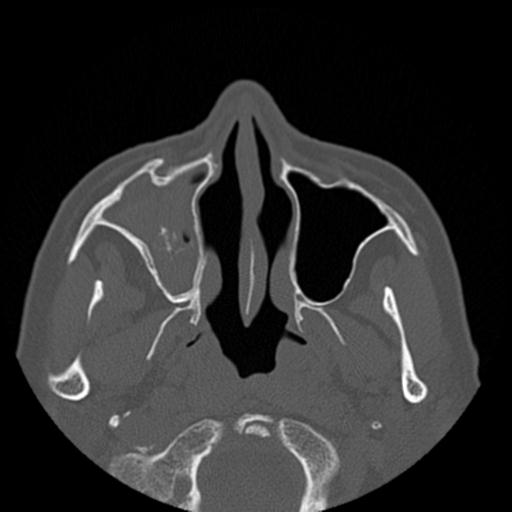 File:Base of skull chondrosarcoma (Radiopaedia 30410-31071 Axial bone window 12).jpg