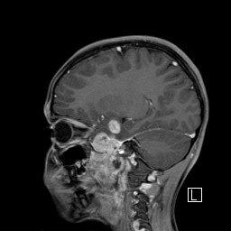 Base of skull rhabdomyosarcoma (Radiopaedia 32196-33142 J 24).jpg