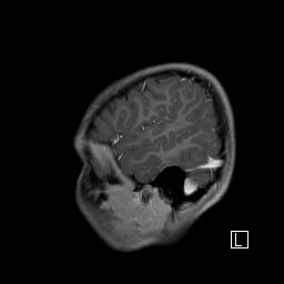 Base of skull rhabdomyosarcoma (Radiopaedia 32196-33142 J 52).jpg