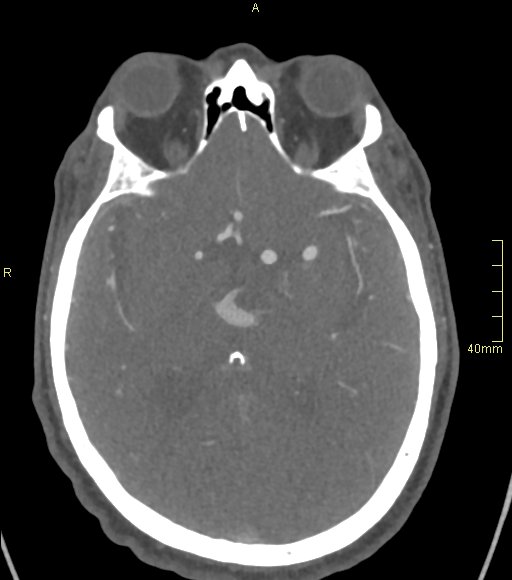 Basilar artery aneurysm (Radiopaedia 56261-62932 A 80).jpg