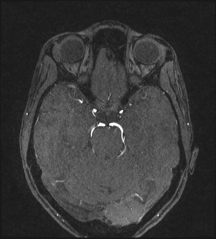 Basilar artery perforator aneurysm (Radiopaedia 82455-97733 Axial MRA 95).jpg