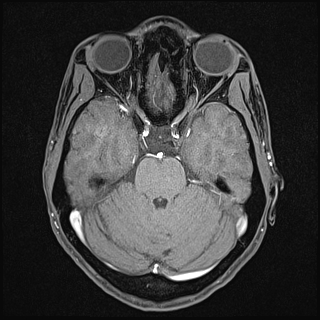 Basilar artery perforator aneurysm (Radiopaedia 82455-97733 Axial T1 fat sat 52).jpg