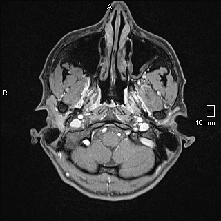 Basilar artery perforator aneurysm (Radiopaedia 82455-99523 G 2).jpg