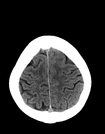 File:Basilar tip aneurysm with coiling (Radiopaedia 53912-60033 Axial 16).jpg
