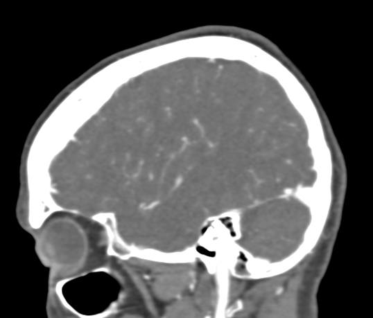 Basilar tip aneurysm with coiling (Radiopaedia 53912-60086 C 27).jpg