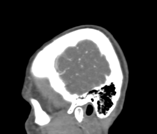Basilar tip aneurysm with coiling (Radiopaedia 53912-60086 C 8).jpg