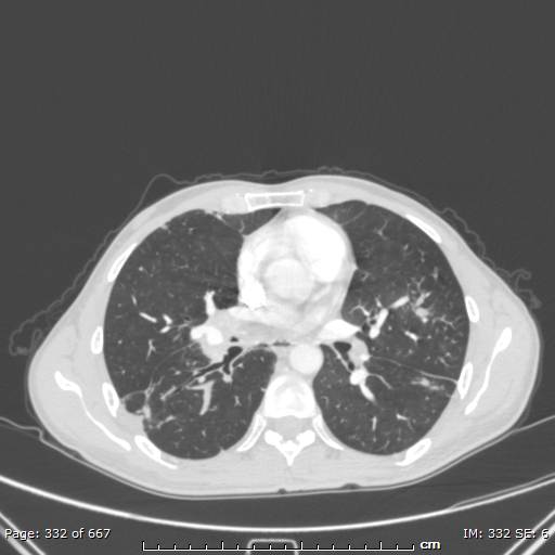File:Behçet disease (Radiopaedia 44247-47889 Axial lung window 43).jpg