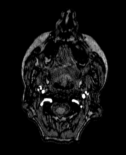 Berry aneurysm of the terminal internal carotid artery (Radiopaedia 88286-104918 Axial TOF 5).jpg