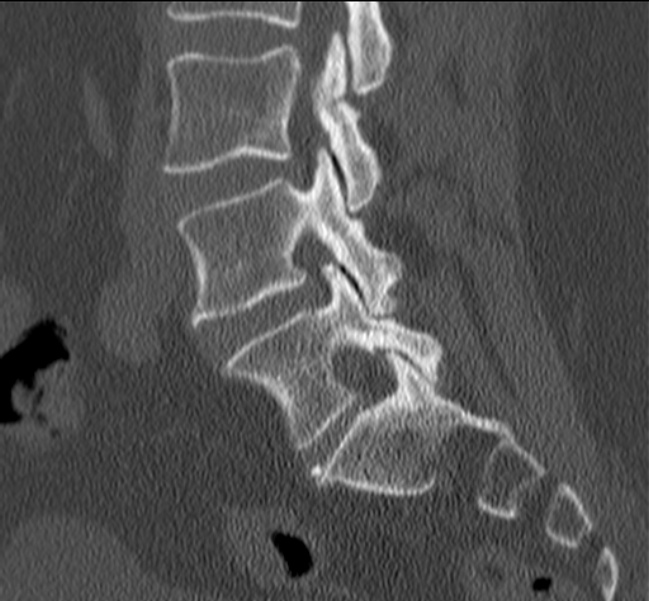 Bertolotti syndrome (Radiopaedia 24864-25128 Sagittal bone window 22).jpg
