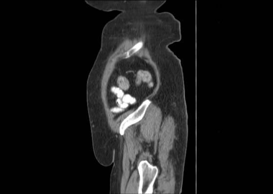 Bicameral celiacomesenteric aneurysm (Radiopaedia 55766-62327 B 51).jpg