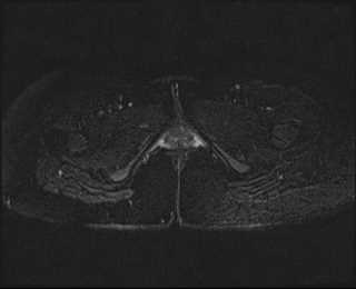 File:Bicornuate bicollis uterus (Radiopaedia 61626-69616 Axial PD fat sat 36).jpg