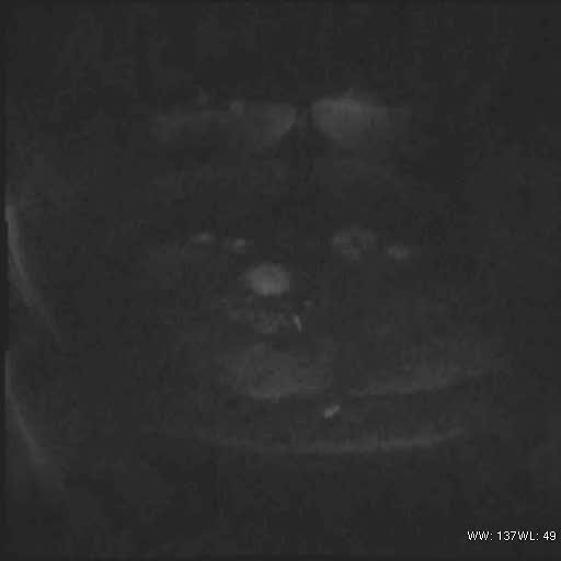File:Bicornuate uterus- on MRI (Radiopaedia 49206-54297 Axial DWI 1).jpg