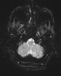 Bifrontal leucotomy (Radiopaedia 36798-38385 Axial SWI 7).png