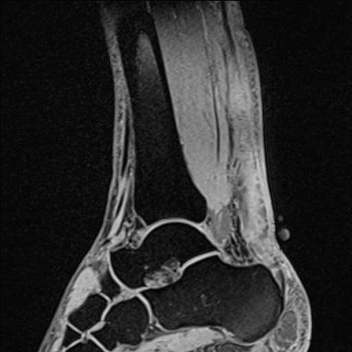 Bilateral Achilles tendon complete tear (Radiopaedia 81344-95051 Sagittal WE - Right 55).jpg
