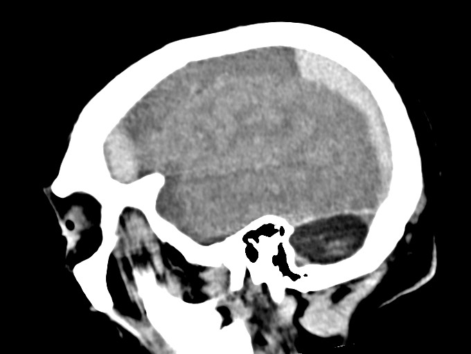 Bilateral acute on chronic subdural hematomas (Radiopaedia 78466-91146 C 16).jpg