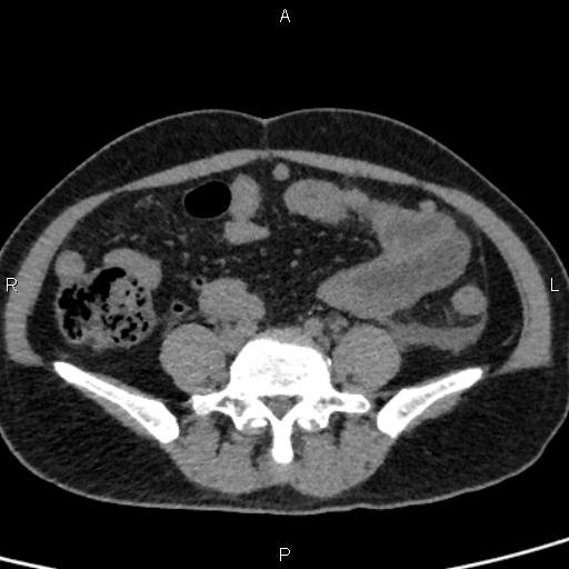Bilateral adrenal gland hyperenhancement in pancreatitis (Radiopaedia 86642-102753 Axial non-contrast 76).jpg