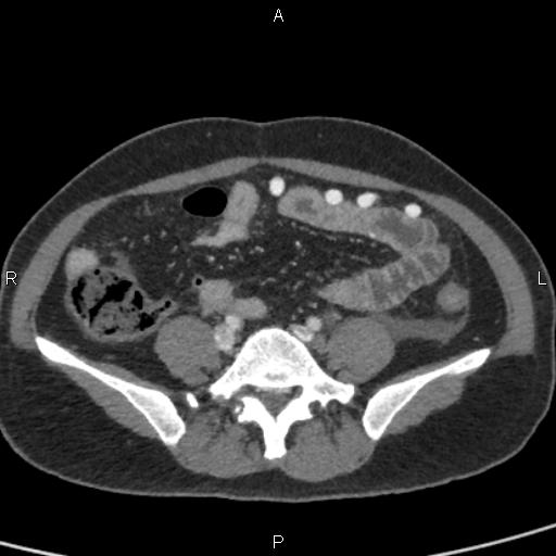 Bilateral adrenal gland hyperenhancement in pancreatitis (Radiopaedia 86642-102753 E 78).jpg