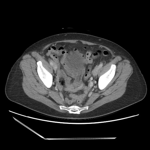 Bilateral adrenal granulocytic sarcomas (chloromas) (Radiopaedia 78375-91007 A 99).jpg