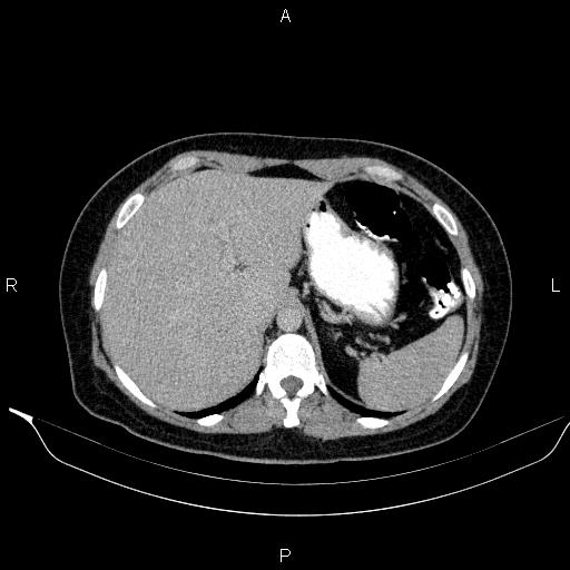 File:Bilateral adrenal myelolipoma (Radiopaedia 63058-71535 Axial C+ delayed 12).jpg