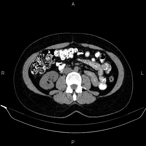 Bilateral adrenal myelolipoma (Radiopaedia 63058-71535 Axial non-contrast 92).jpg