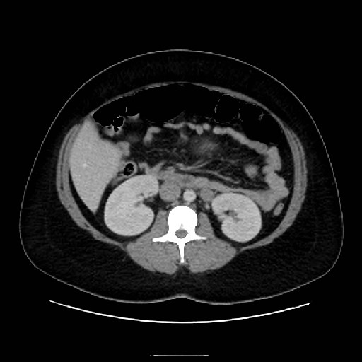 Bilateral adrenal thrombosis (Radiopaedia 58182-65256 A 32).jpg