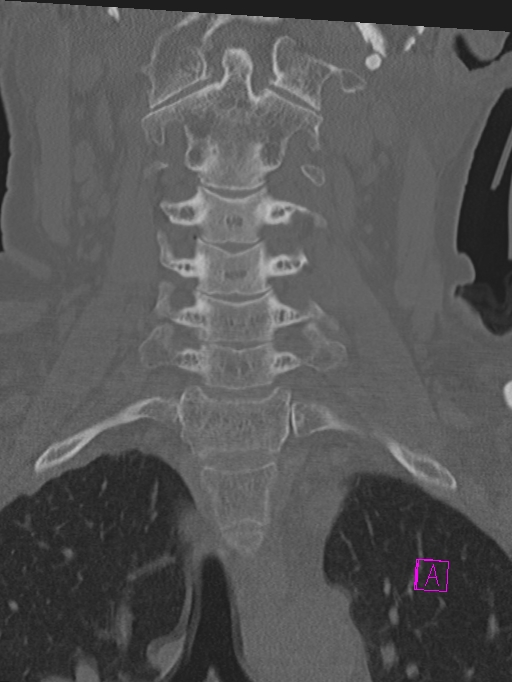 Bilateral atlanto-occipital assimilation (Radiopaedia 28350-28603 Coronal bone window 16).jpg