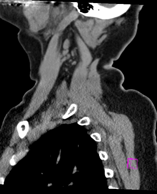 Bilateral atlanto-occipital assimilation (Radiopaedia 28350-28603 D 68).jpg