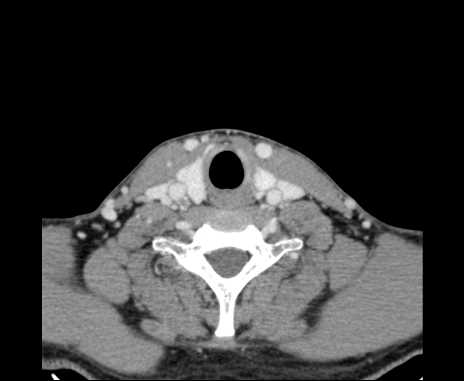 File:Bilateral carotid body tumors (Radiopaedia 61841-69870 Axial Post contrast 86).jpg
