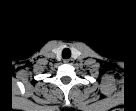 Bilateral carotid body tumors (Radiopaedia 61841-69870 Axial non-contrast 95).jpg