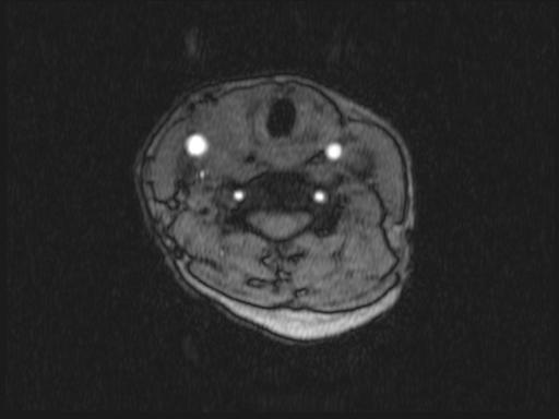File:Bilateral carotid body tumors and right jugular paraganglioma (Radiopaedia 20024-20060 Axial 345).jpg