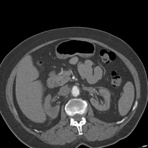 File:Bilateral delayed nephrogram from renal artery stenosis (Radiopaedia 47681-52362 A 23).png