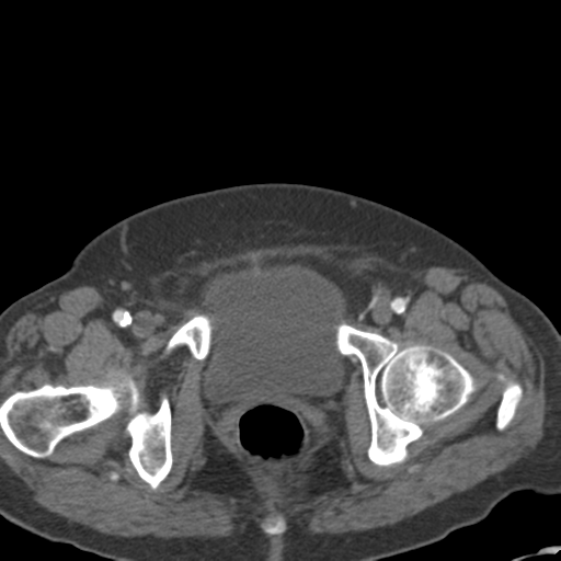 File:Bilateral delayed nephrogram from renal artery stenosis (Radiopaedia 47681-52362 A 64).png