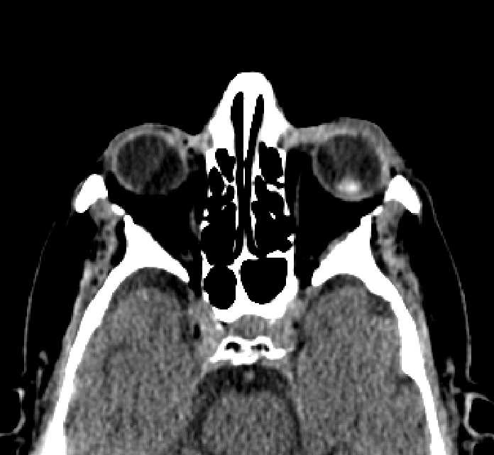 Bilateral ectopia lentis (Radiopaedia 89889-107013 Axial non-contrast 51).jpg