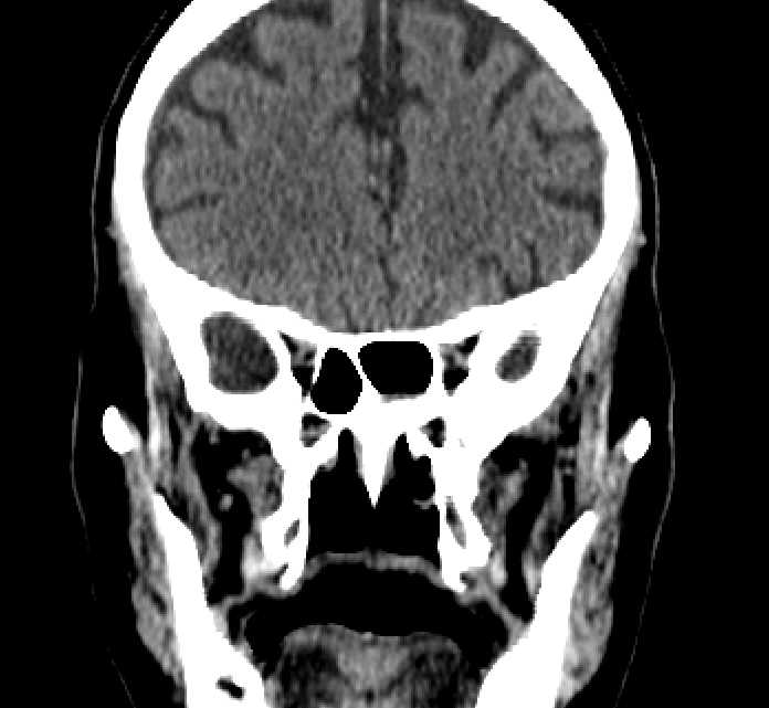 Bilateral ectopia lentis (Radiopaedia 89889-107013 Coronal non-contrast 102).jpg