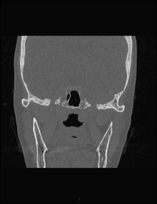 Bilateral frontal mucoceles (Radiopaedia 82352-96454 Coronal 251).jpg